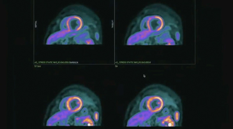 Identification of In-stent restenosis