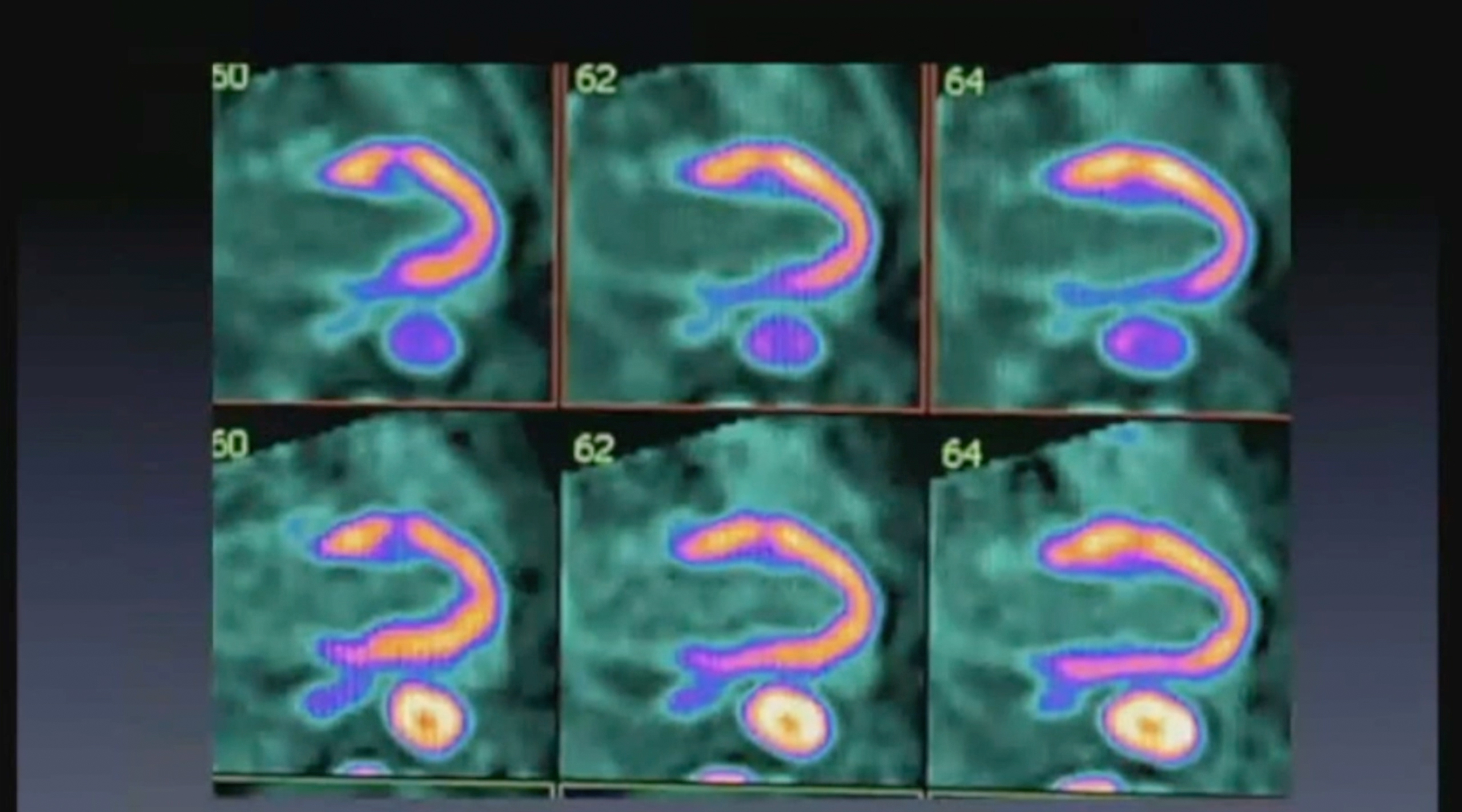 Precision Cardiology: Advanced Diagnostics for Complex Coronary Artery Challenges