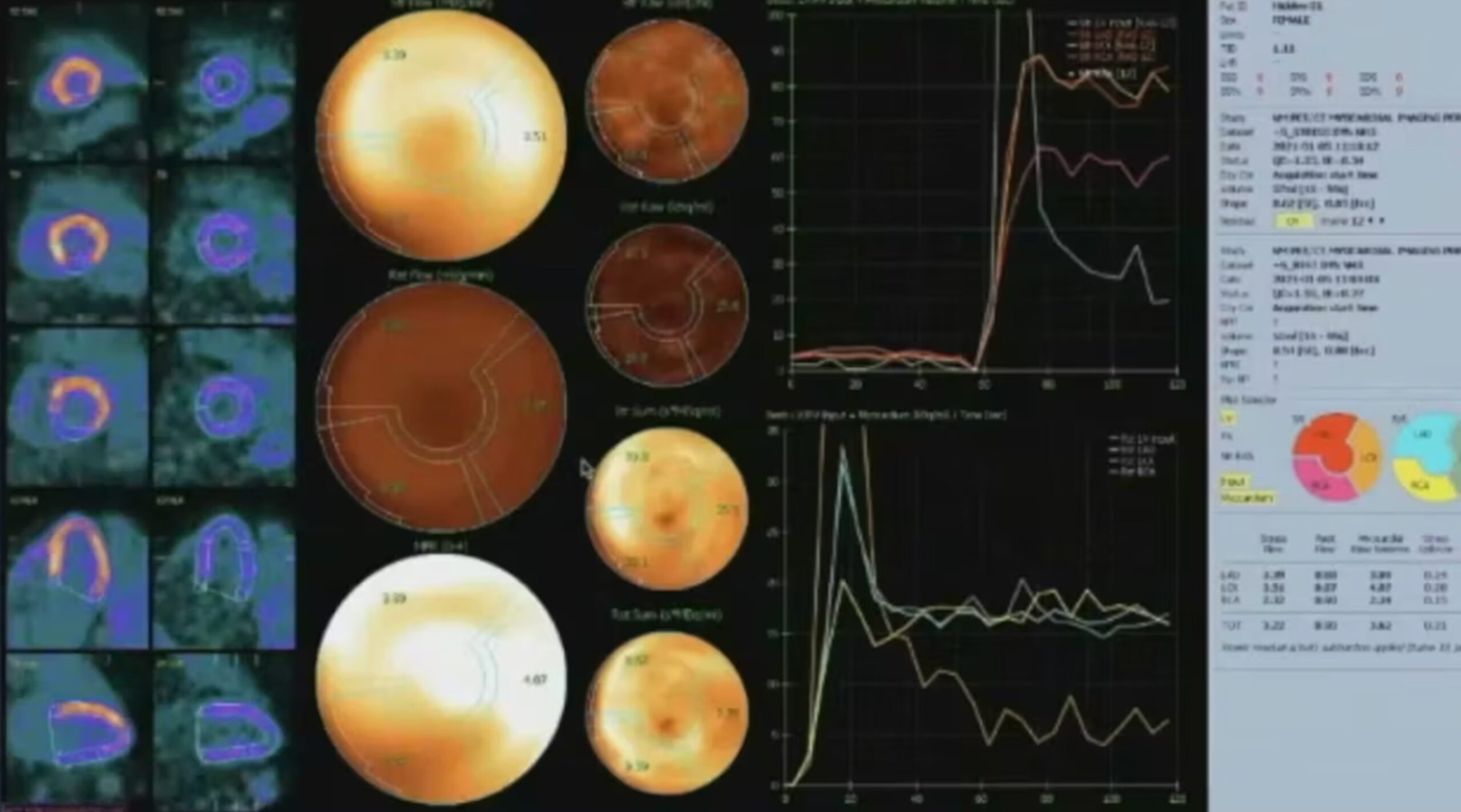 Cardiac N-13 Ammonia Can Resolve Equivocal Soft Tissue Attenuation SPECT Artifacts