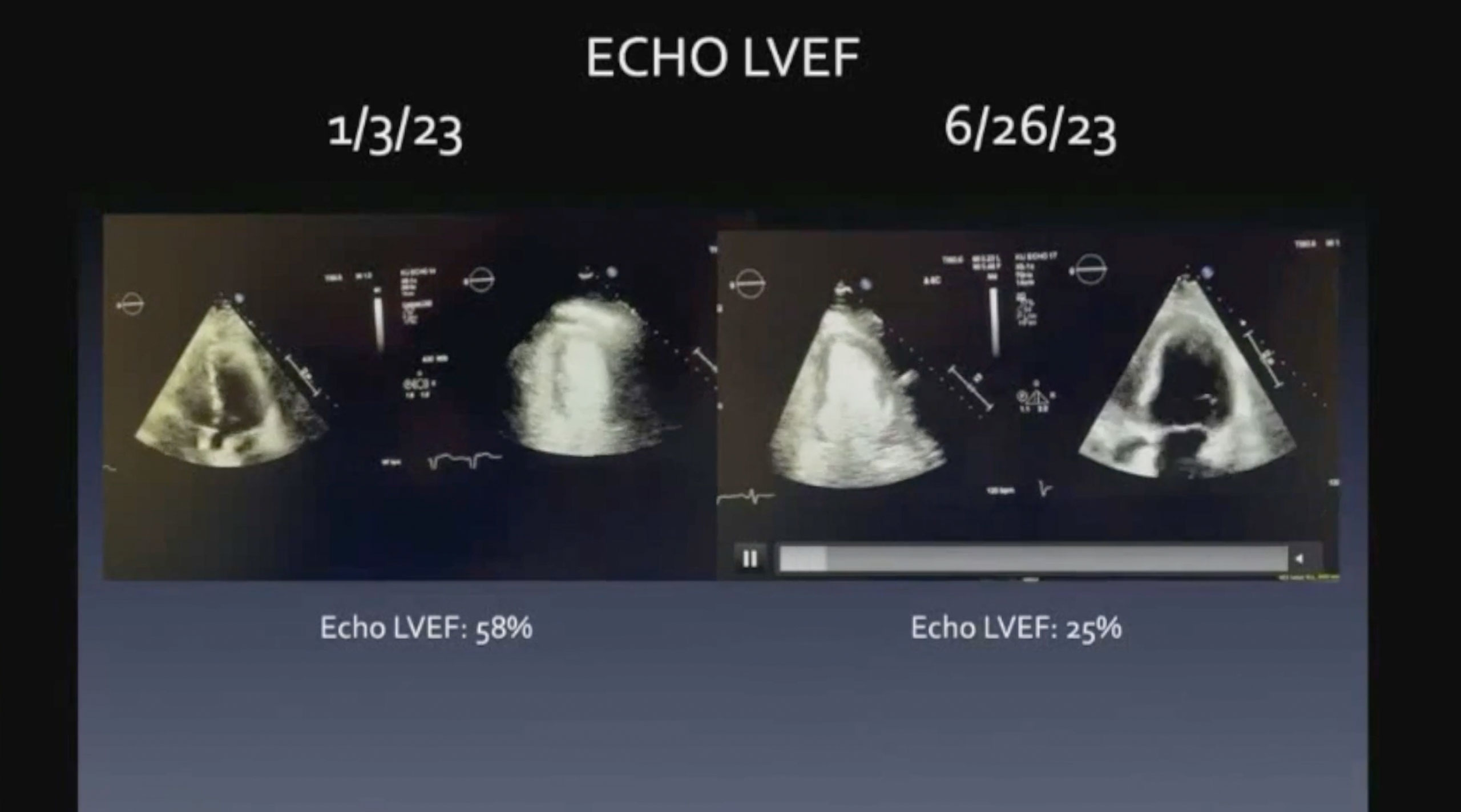 Silent Threat: Decoding Cardiac Transplant Vascular Disease (CAV)