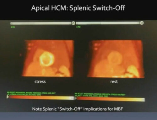 Imaging Hypertrophic Cardiomyopathy using N-13 Ammonia