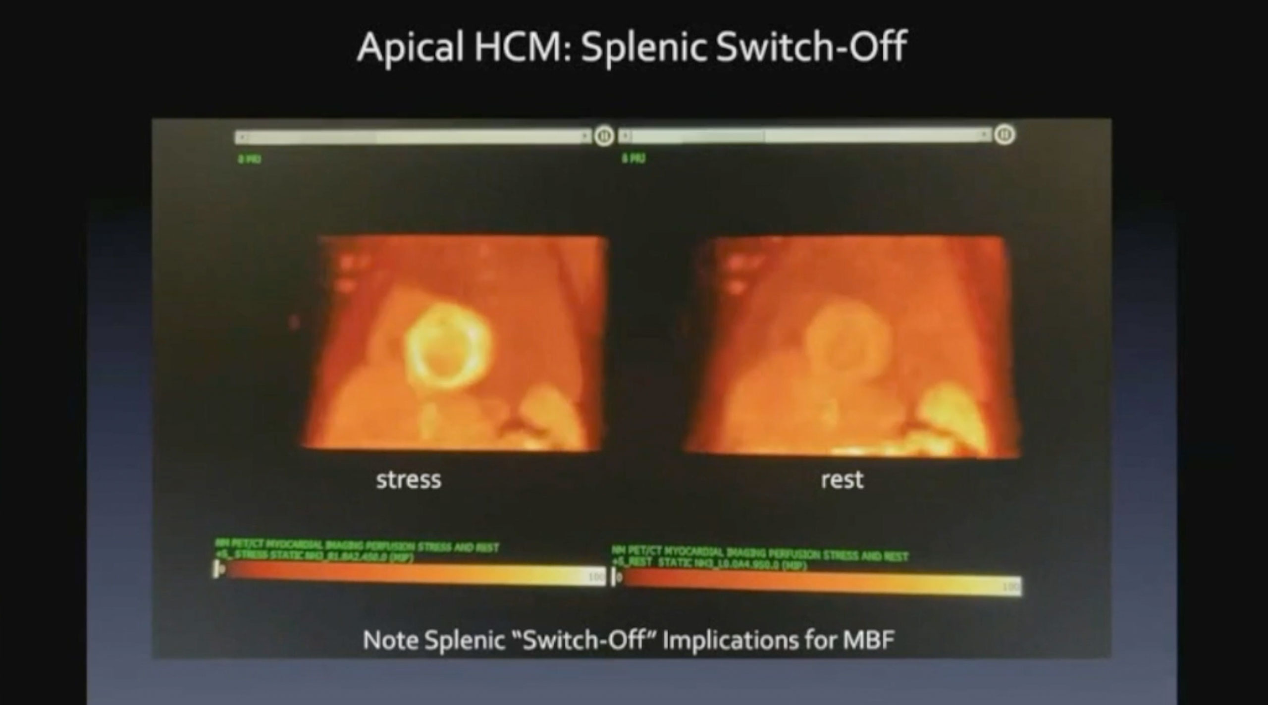 Imaging Hypertrophic Cardiomyopathy using N-13 Ammonia