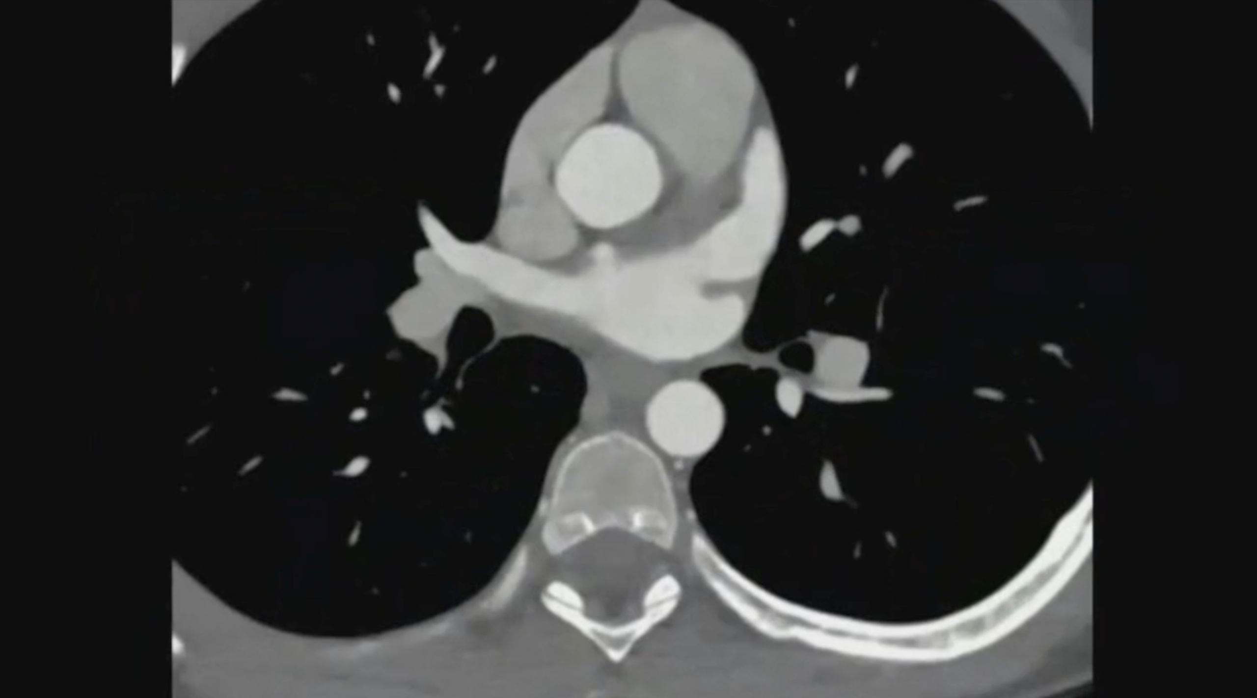 Identification of Kawasaki’s disease in pediatric patient using N-13 Ammonia