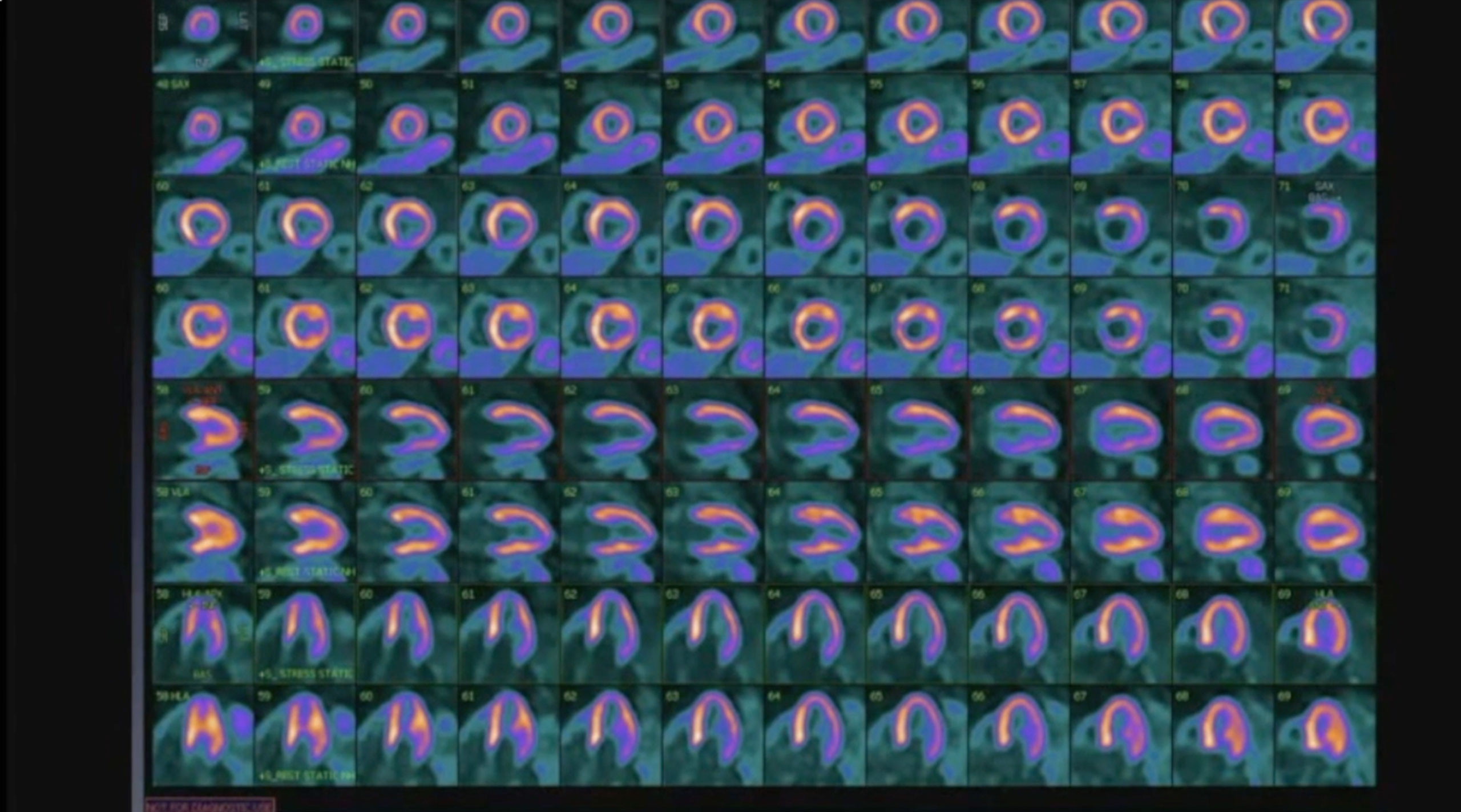 Failure of D-SPECT to assess risk resolved with N-13 Ammonia