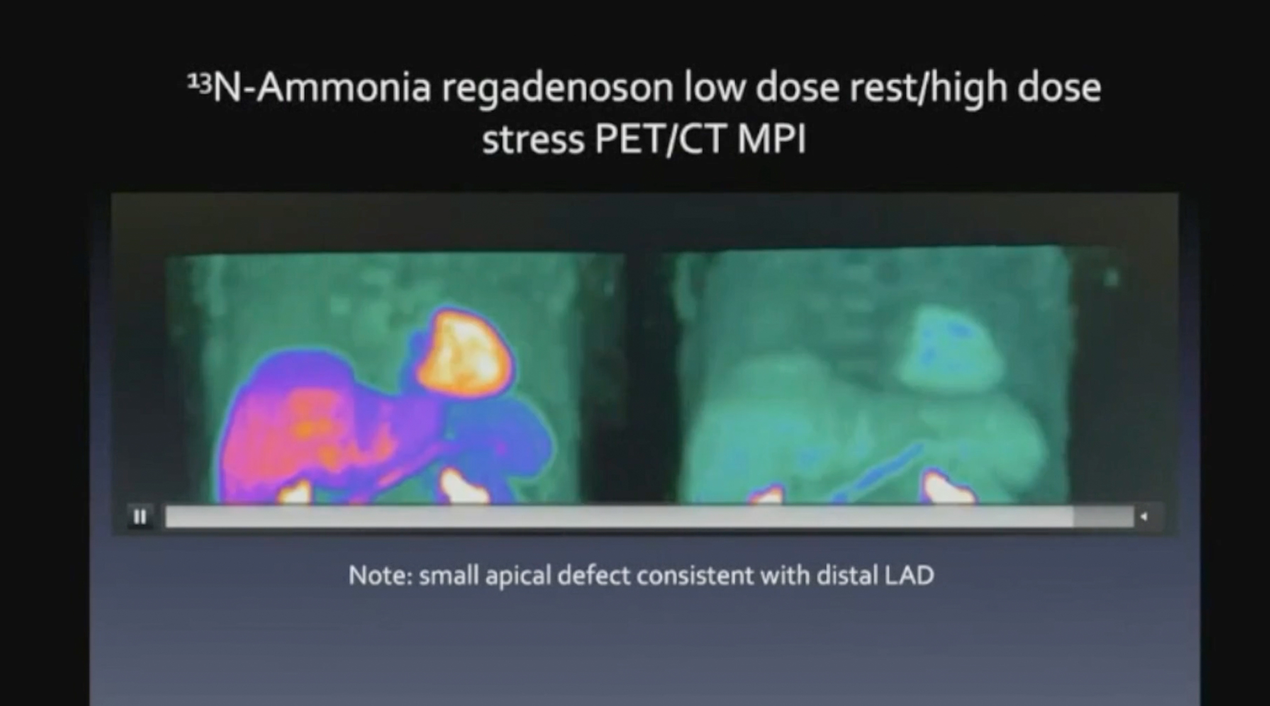 Systemic Sclerosis Case Study: Cardiac Imaging Findings