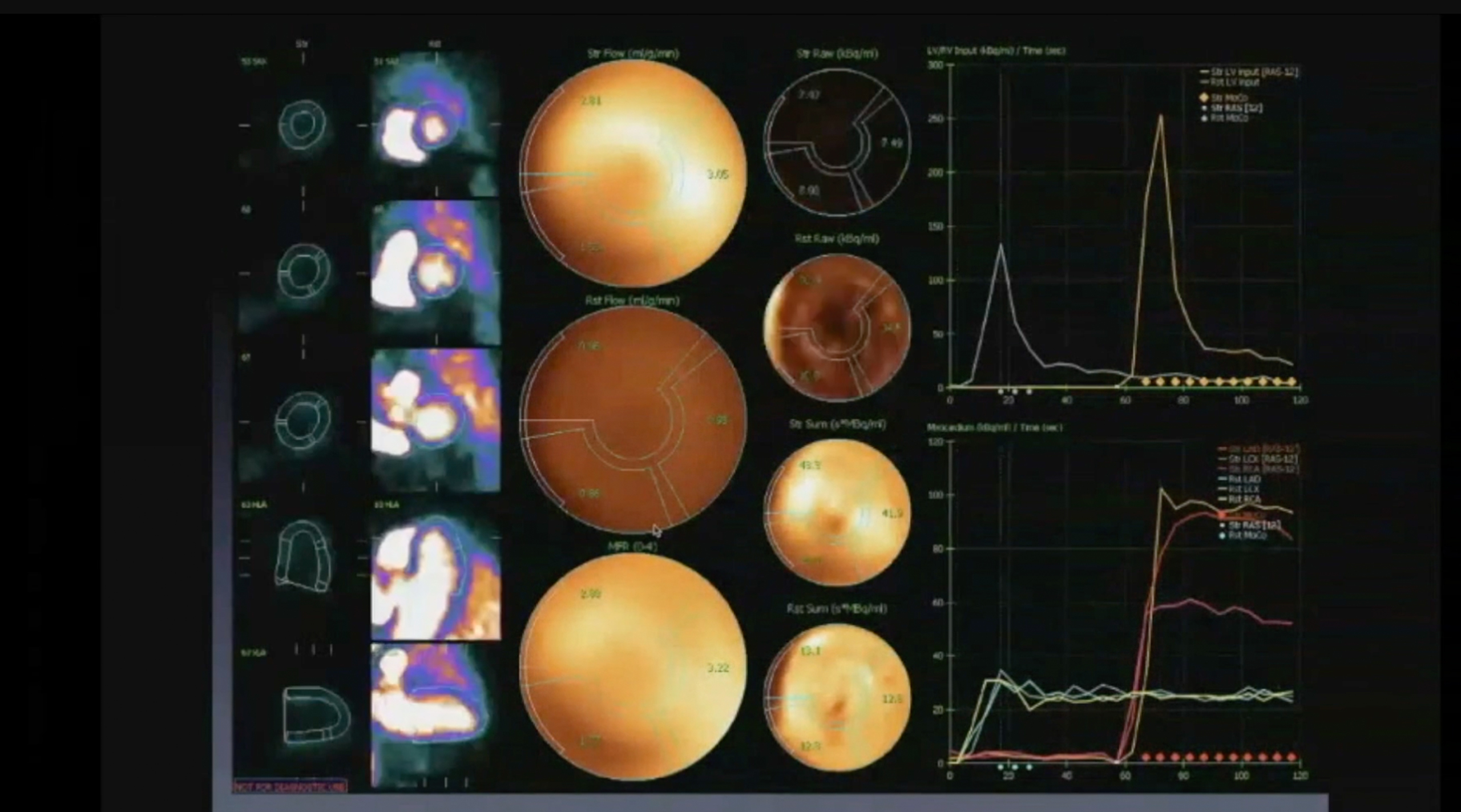 Identifying potential in-stent restenosis with new onset of chest pain with N-13 Ammonia Cardiac PET/CT